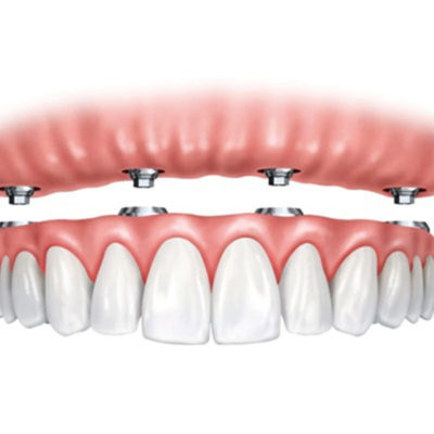 All-on-4/6 Implant System